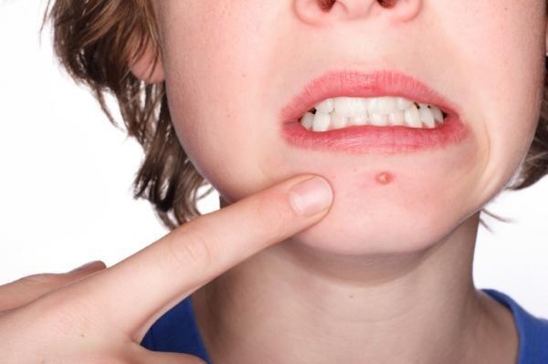 Trị được mụn trứng cá