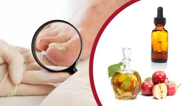Các hoạt chất được cho là tạo độ pH cho giấm sẽ tiêu diệt nấm móng chân.