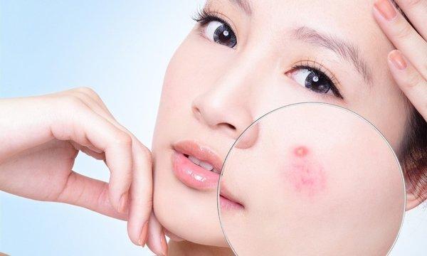 Chữa trị và nghe theo lời khuyên của bác sĩ da liễu