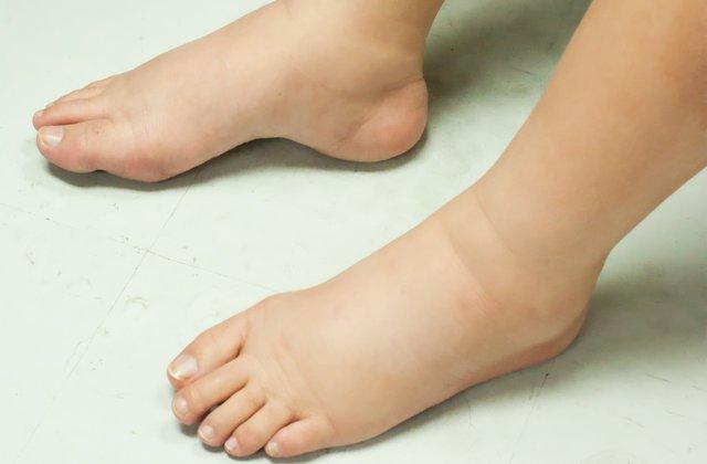 Cơ thể có dấu hiệu sưng, phù nề