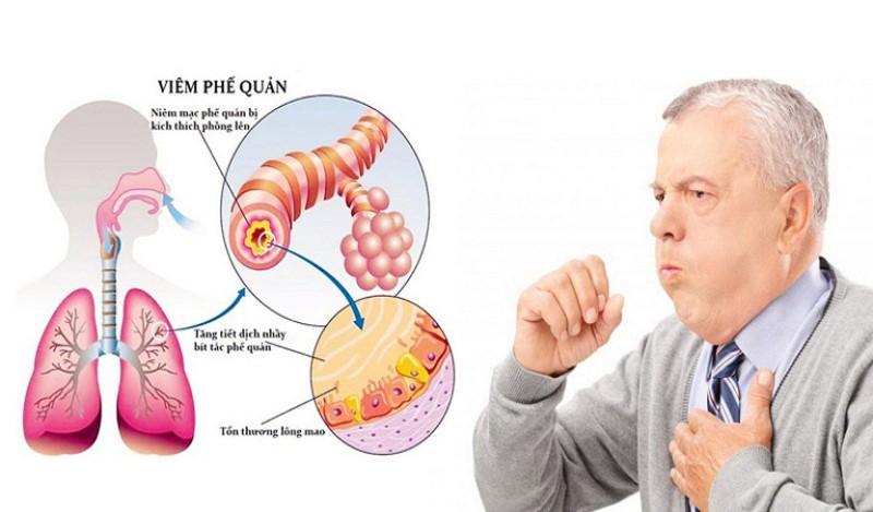 Công dụng của Levodropropizine