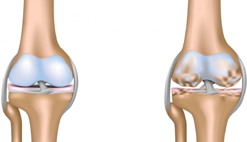 Xương bình thường và xương bị tổn thương