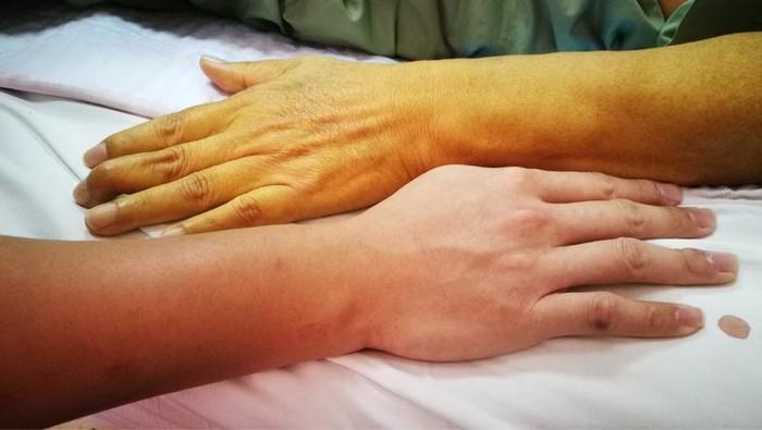 Vàng da dấu hiệu của bệnh gan