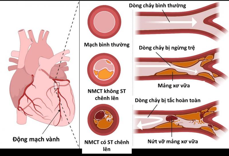 Dấu hiệu nhận biết nhồi máu cơ tim