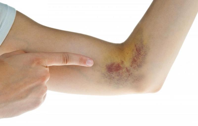 Vết bầm tím lâu tan