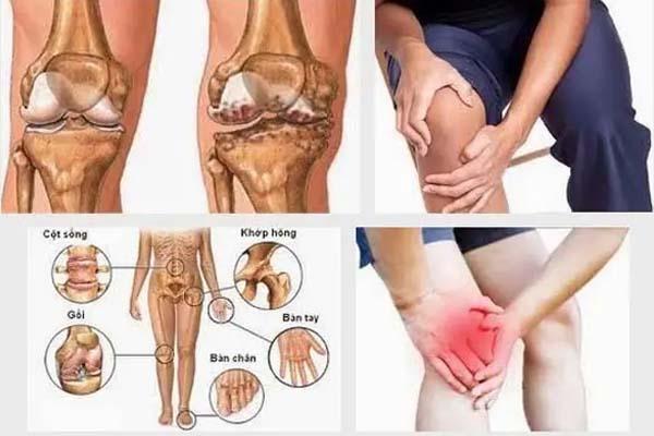 Nếu trong gia đình có người bị bệnh liên quan đến khớp thì khả năng đời sau sẽ mắc khớp tỉ lệ lên tới 90%.