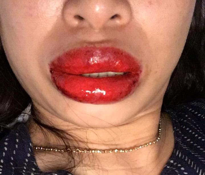 Dị ứng khi phun xăm