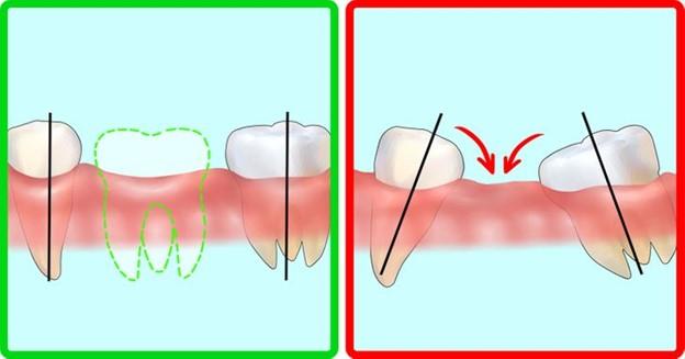 Điều gì sẽ xảy ra nếu bạn mất một chiếc răng trong thời gian dài ?