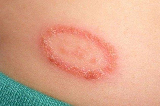 Vết cắn của kiến ba khoang