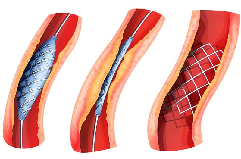 Điều trị bệnh động mạch ngoại biên