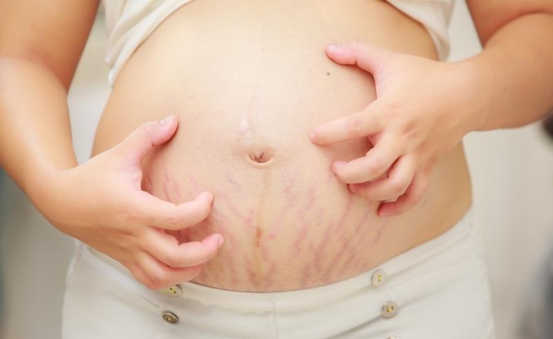 Điều trị rạn da