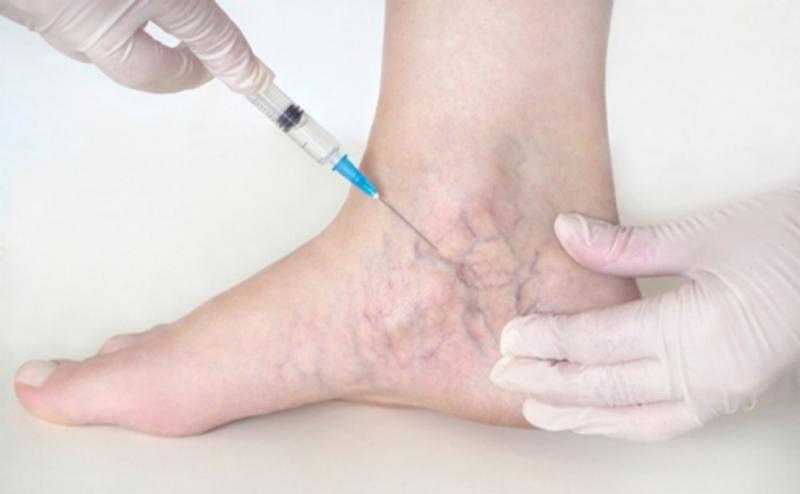 Điều trị suy giãn tĩnh mạch sâu