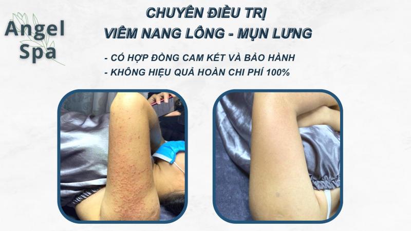 Điều Trị Viêm Nang Lông Đà Nẵng - Angel Spa
