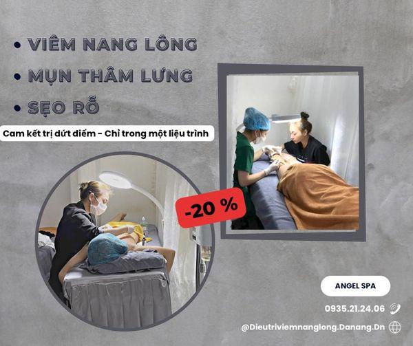 Điều Trị Viêm Nang Lông Đà Nẵng - Angel Spa