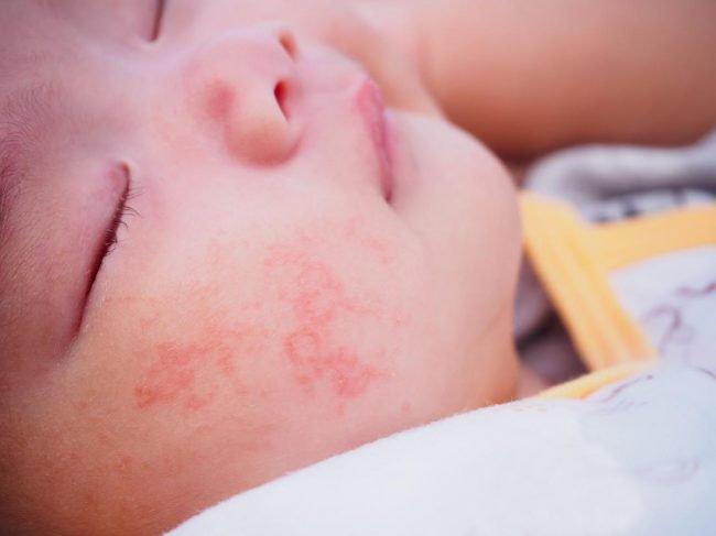 Đối với các bé trên 1 tuổi bị dị ứng đạm sữa bò