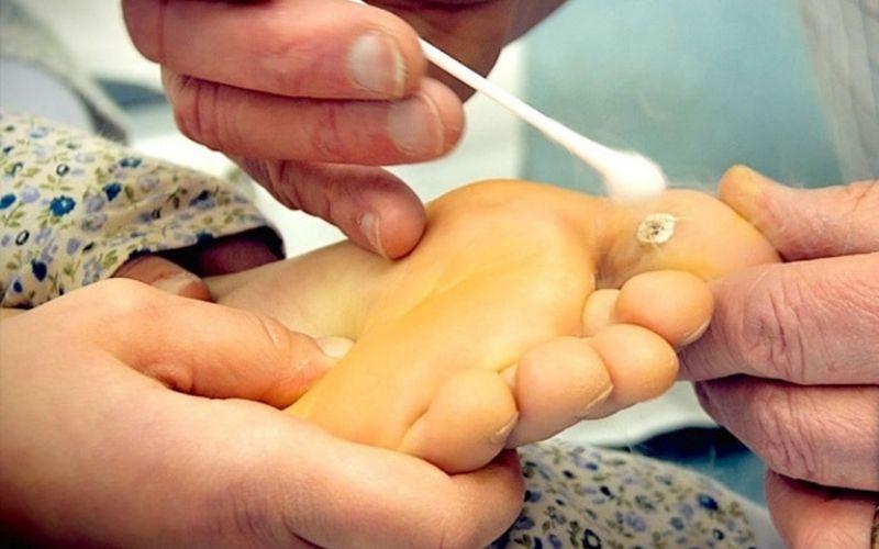 Dùng đu đủ trị mụn cóc