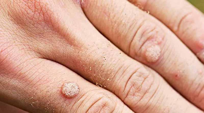 Dùng giấm táo trị mụn cóc