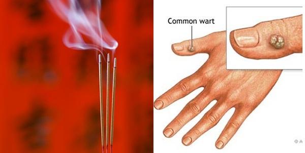 Dùng nhang trị mụn cóc