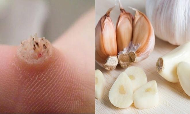 Dùng tỏi điều trị mụn cóc