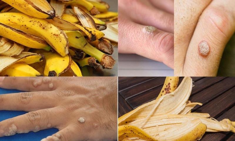 Dùng vỏ chuối trị mụn cóc