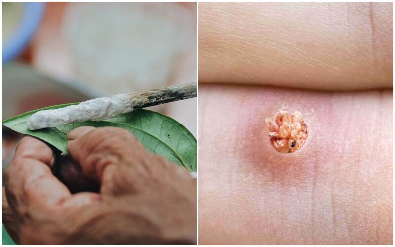 Dùng vôi ăn trầu trị mụn cóc