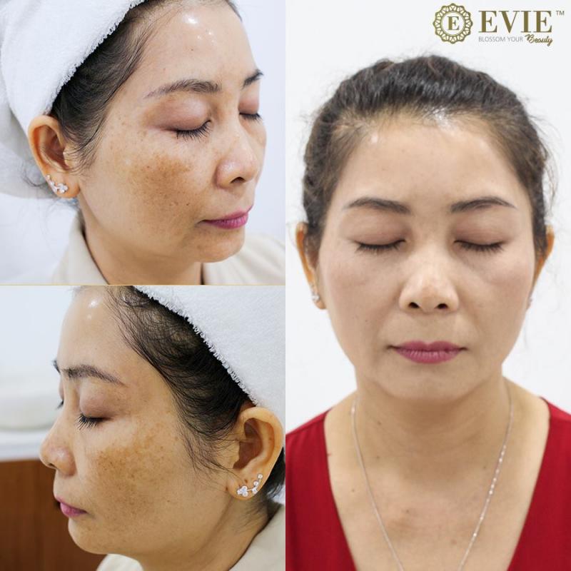 Evie Clinic & Spa - Phòng khám chuyên khoa Da liễu Công nghệ cao