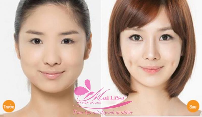 THẨM MỸ VIỆN MAILISA