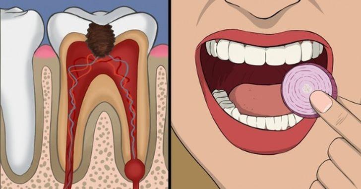 Giảm đau răng khôn bằng hành tây