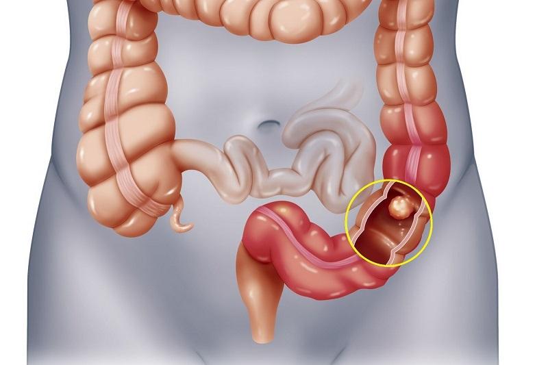 Giảm khả năng sống sót khi bị ung thư ruột già