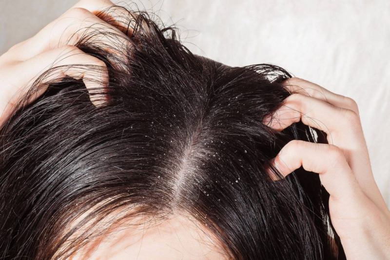 Uống nước ấm mỗi ngày Giữ cho da đầu luôn ẩm không bị ngứa ít gàu