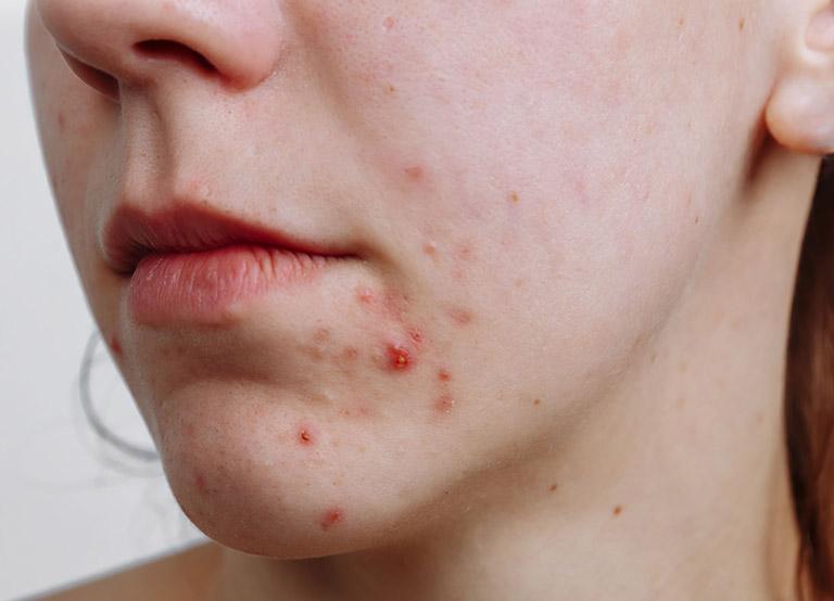 Da bị mụn do dùng sản phẩm không phù hợp