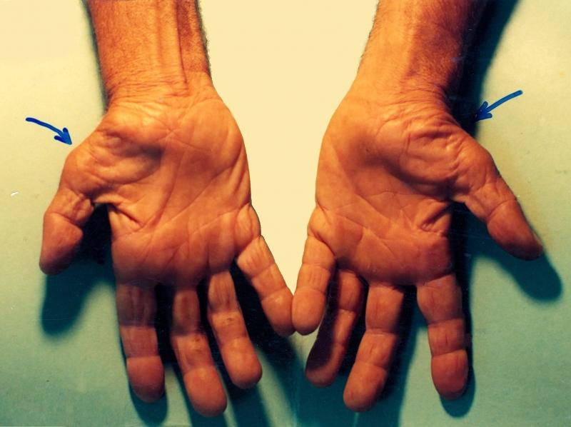 Làm việc nhiều với máy tính và sai tư thế còn dẫn tới hội chứng ống cổ tay