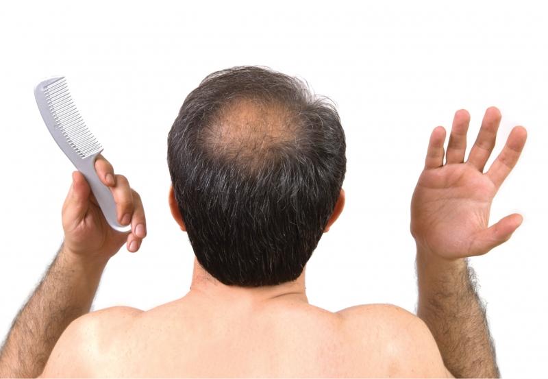 Hói đầu của nam giới có thể di truyền từ mẹ