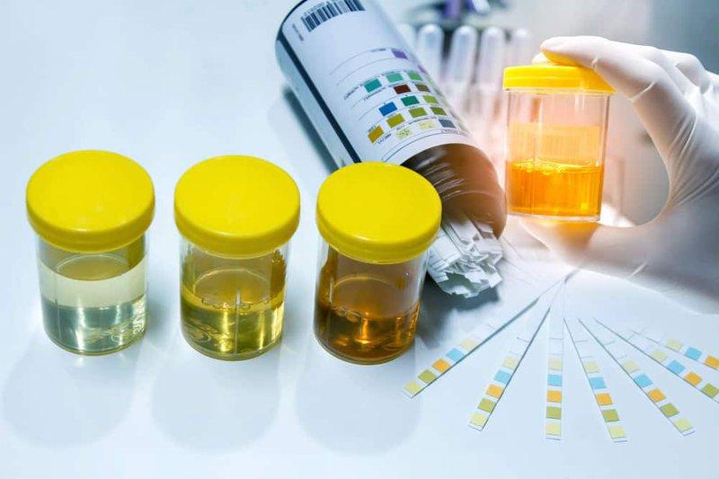 Hướng dẫn lấy nước tiểu giữa dòng