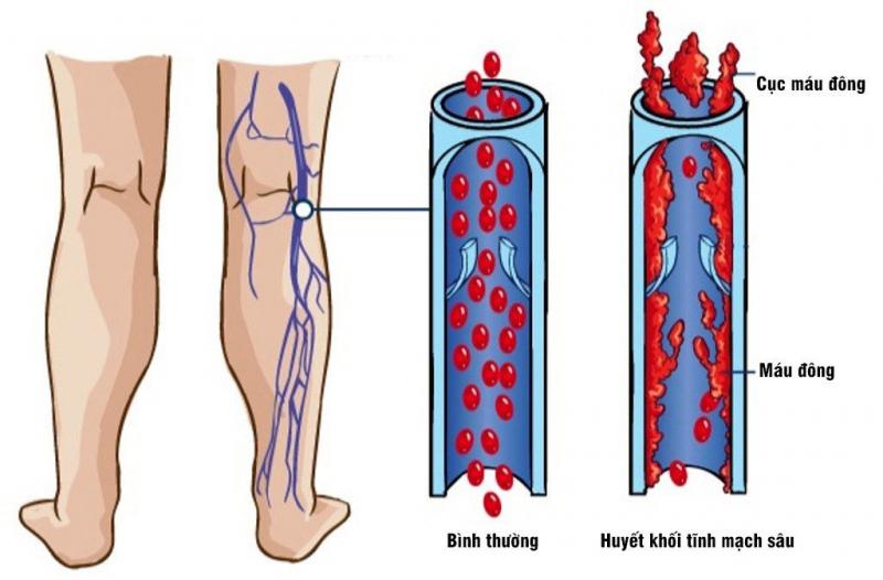 Huyết khối tĩnh mạch sâu