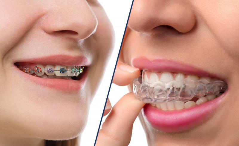 Invisalign có thể được sử dụng để điều trị các vấn đề niềng răng phức tạp không?
