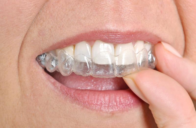 Invisalign có thể giúp giảm đau và không thoải mái như niềng răng truyền thống hay không?