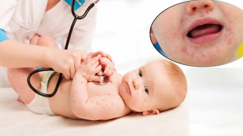 Khó thở là một trong những dấu hiệu quan trọng không nên bỏ qua khi trẻ bị tay chân miệng