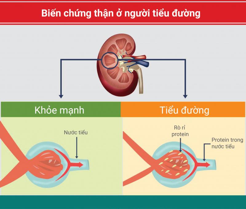 Kiểm soát bệnh tiểu đường tốt hơn