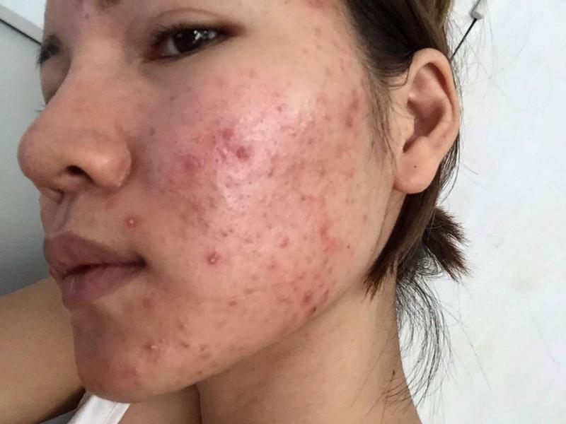 Mụn viêm, mụn ẩn và nang mụn