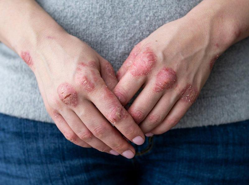Làm dịu tình trạng bệnh vẩy nến