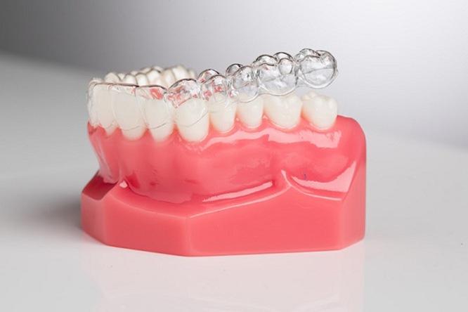 Làm thế nào Invisalign hoạt động để điều chỉnh vị trí của răng?