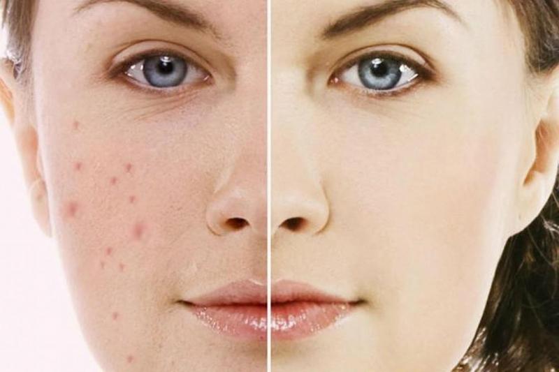 Xông hơi mặt loại bỏ vi khuẩn và tế bào chết gây ra mụn trứng cá