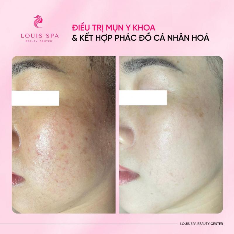 Louis Spa - Trung Tâm Thẩm Mỹ Công Nghệ Cao