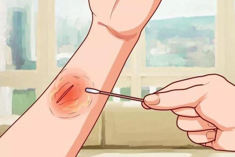Thận trọng khi sử dụng đối với những vết thương hở