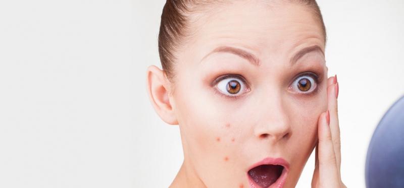 Da có mụn là da không được làm sạch đúng cách