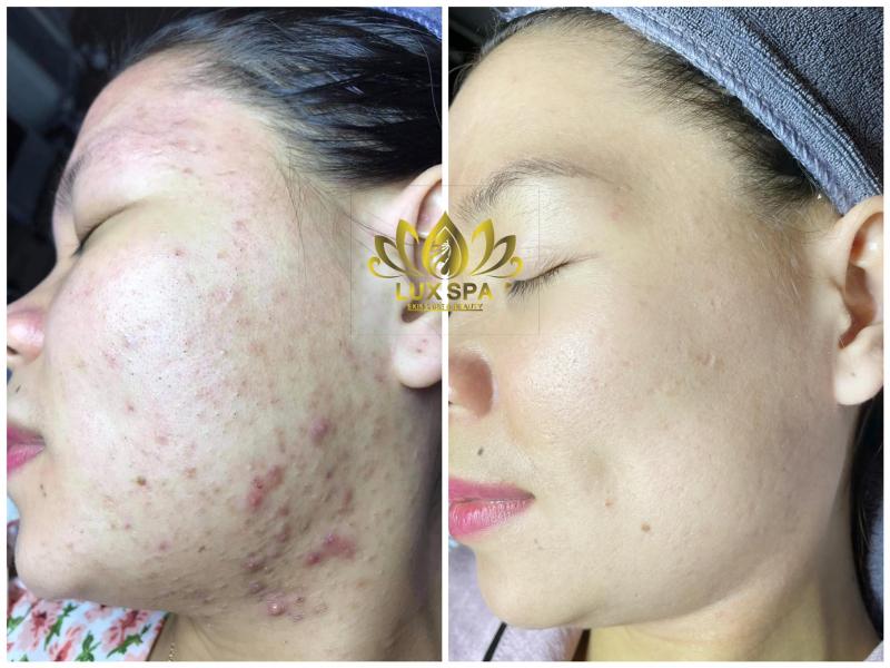 Lux Spa chuyên trị mụn ,lăn phi kim, thâm do mụn, tắm trắng, triệt lông, chăm sóc da,phun thêu thẩm mỹ, thư giãn