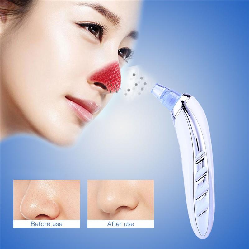 Máy loại bỏ mụn đầu đen Kemei