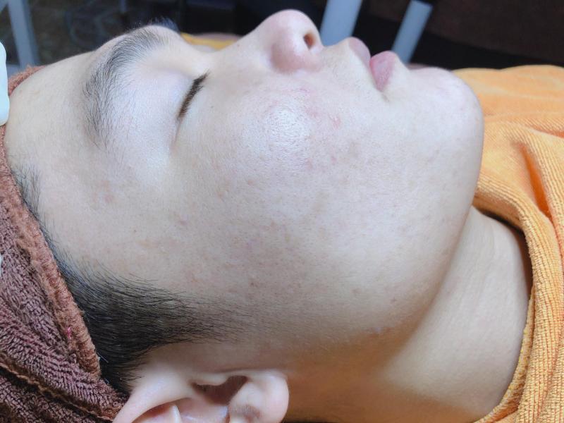 Sau khi trị liệu tại MÂY Spa