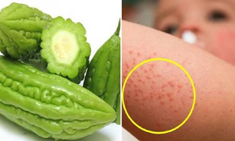 Mẹo chữa rôm sẩy cho bé